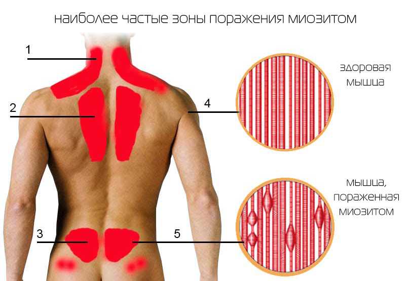 Как избавиться от сквозняка в квартире и доме чем страшен сквозняк в помещении